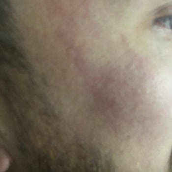 Claderm Kill Maske Yanığı