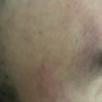 Claderm Kill Maske Yanığı