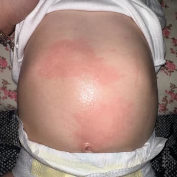 Goon Bebek Bezi Bebek Bezi Alerjisi Ve Kalite Kaygısı