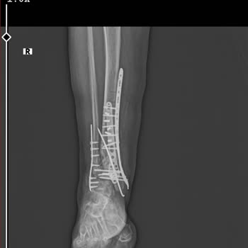 Kocaeli Derince Eğitim ve Araştırma Hastanesi Heyet Raporu Yanlış Verildi