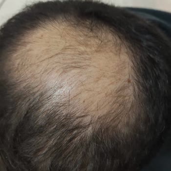 Bellapais Güzellik ve Ayak Sağlığı'nda Yaptırdığım Saç Dolgusunun Etkisi Olmadı