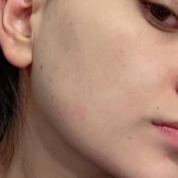 Yves Rocher Bakım Ürünleri Alerjik Reaksiyon