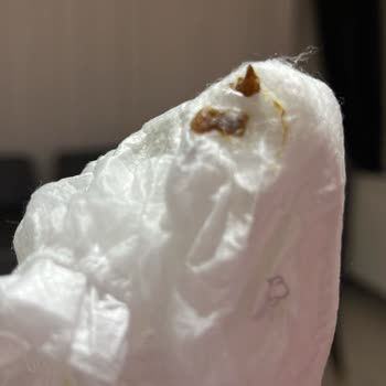 Sleepy Natural Bezin İçinden Yabancı Cisim Çıktı