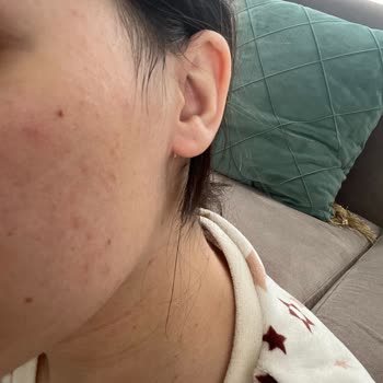 Bioderma Yüzümü Yaktı Ve Sivilce Tarlasına Gönderdi!