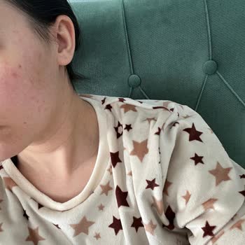 Bioderma Yüzümü Yaktı Ve Sivilce Tarlasına Gönderdi!