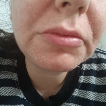 Maruderm Ürünleri Cildimi Yara Yaptı.