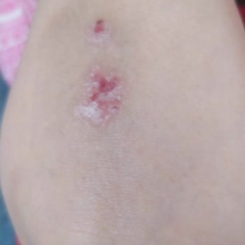 Şölen Çikolata Bulaşıcı Hastalıklar Ve Hijyen