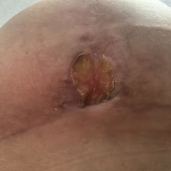 Op. Dr. Dürdane Keskin Meme Dikleştirme Ameliyatı