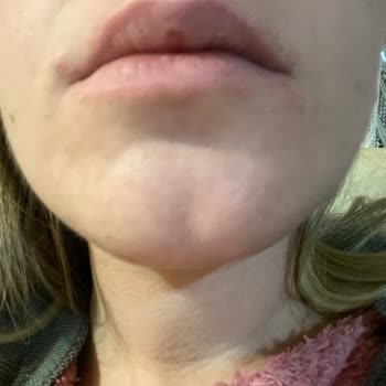 Clinique Nemlendirici Sivilce Yaptı