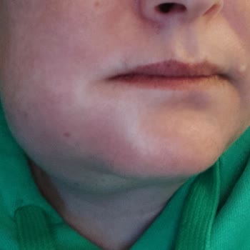 Nuh Çimento Ağız ve Diş Sağlığı Merkezi Doktorun İhmalkarlığı Sonucu Yaşanan Sağlık Sorunları