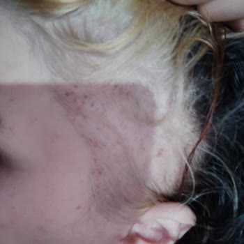 Palette Gümüş Sarı Rengi Alerjik Reaksiyon