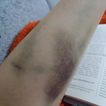 Beytepe Murat Erdi Eker Devlet Hastanesi Kan Alımı İle Şişlik