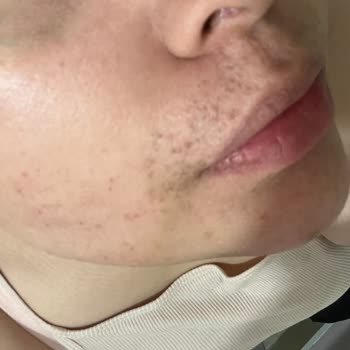 Songül Yıldırım Beauty Yüzümde Leke Ve Derin İzler Kaldı