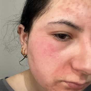 Watsons Ürünleri Yüzünden Süratim Mahvoldu