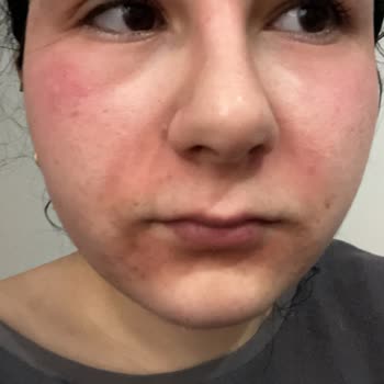 Watsons Ürünleri Yüzünden Süratim Mahvoldu