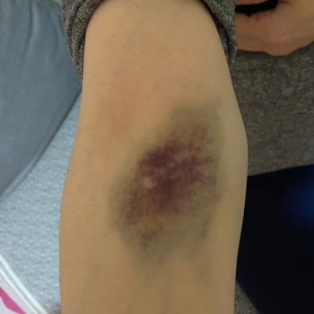 Zekai Tahir Burak Kadın Sağlığı Eğitim Ve Araştırma Hastanesi Özensiz Kan Alımı