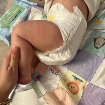 Mustela Krem Kızarıklık Yaptı