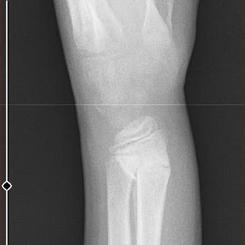 Özel Ege İnci Tıp Merkezi Çocuğun Kolunun Yanlış Kaynaması Ve Hastane Süreciyle İlgili Şikayet