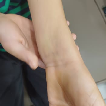 Özel Ege İnci Tıp Merkezi Çocuğun Kolunun Yanlış Kaynaması Ve Hastane Süreciyle İlgili Şikayet