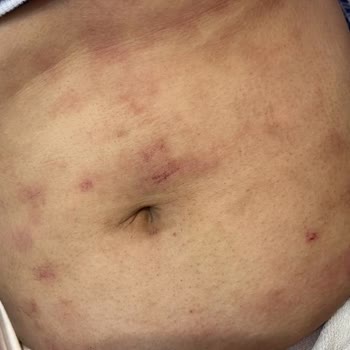 Vip İstanbul Güzellik (Isparta) Cildimdeki Yanıklar Gitmeden Araştırın