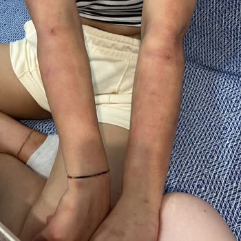 Vip İstanbul Güzellik (Isparta) Cildimdeki Yanıklar Gitmeden Araştırın