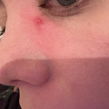 Nyx Bare With Me Concealer Caused Acne Explosion!