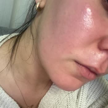 SHE Vec Kırmızı Peeling Yüzümü Yaktı