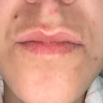 Missha Alerjik Reaksiyon Ve Ciddi Sivilcelenme