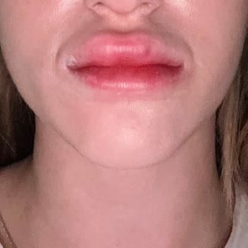 Dr. Nüket Eroğlu Dudağımı Mahvettiler! Bıyık Bölgeme Taştı
