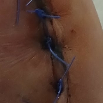 Samsun Eğitim ve Araştırma Hastanesi Doktor Dan Ayak Kirik