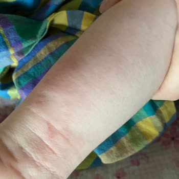 Cansın Sağlık Gereçleri Yara Bandı Alerji Yapıyor