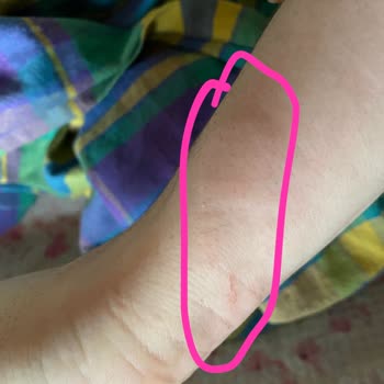 Cansın Sağlık Gereçleri Yara Bandı Alerji Yapıyor