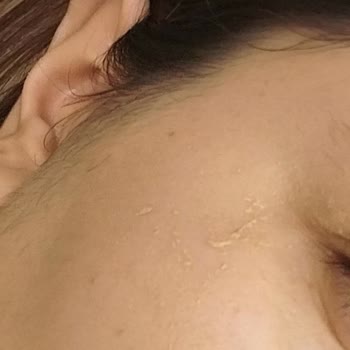 The Purest Solutions Güneş Kremi Soyulma Sorunu