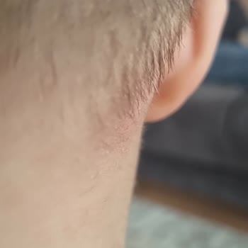 Helba Losyonda Ne Gibi Bir Yan Etki Olabilir?