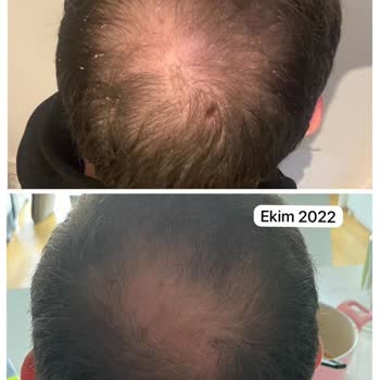 Este Medica Saç Ekimi Hüsranı: Vaatler Ve Gerçekler