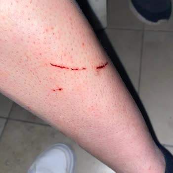 Burger King Kedi Saldırısına Uğradım