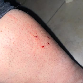 Burger King Kedi Saldırısına Uğradım