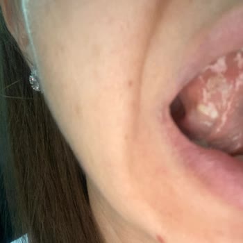 Sensodyne Diş Macunu Ağız Yarası Problemi