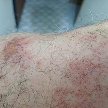 Bioder Tüy Dökücü Sprey Şikayet (cilt Yanığı)