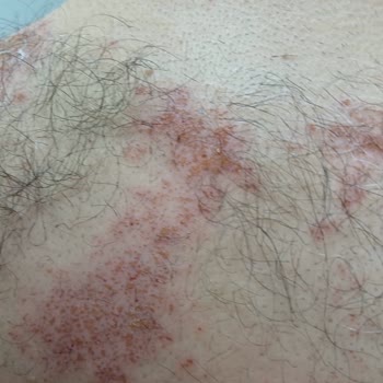 Bioder Tüy Dökücü Sprey Şikayet (cilt Yanığı)