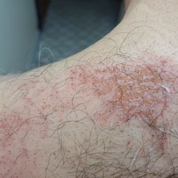 Bioder Tüy Dökücü Sprey Şikayet (cilt Yanığı)