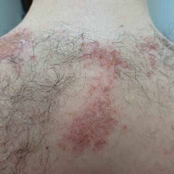 Bioder Tüy Dökücü Sprey Şikayet (cilt Yanığı)