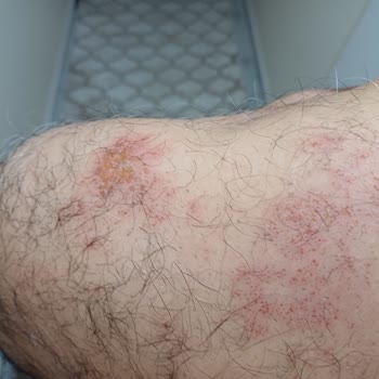 Bioder Tüy Dökücü Sprey Şikayet (cilt Yanığı)