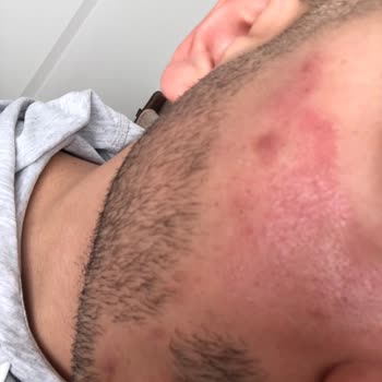 Claderm Kil Maskesi Problemi