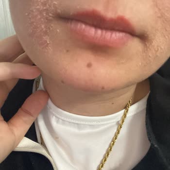 Loreal Paris Mağduriyet Cildim Çok Tahriş Oldu