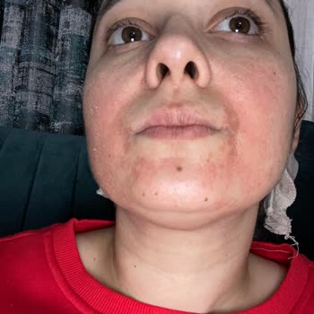 Loreal Paris Mağduriyet Cildim Çok Tahriş Oldu