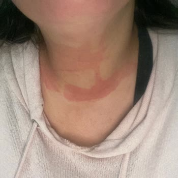 Dermokil C Vitaminli Serum Yanığı