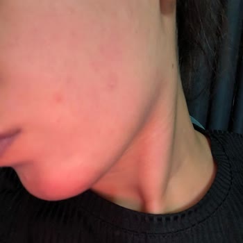 The Purest Solutions The Purest Tonik Ve Kırmızı Peeling