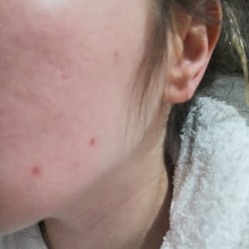 Day2day Yüzümde Sivilce Ve Küçük Kırmızı Kabarcıklar Oluşturdu