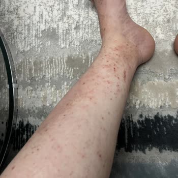 Mustela Çatlak Kremi Alerji Yaptı